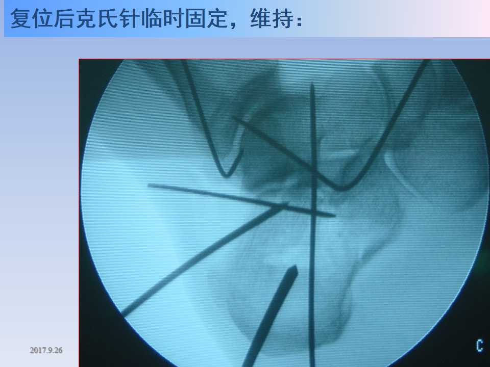 跟骨骨折的临床治疗方式及其要点