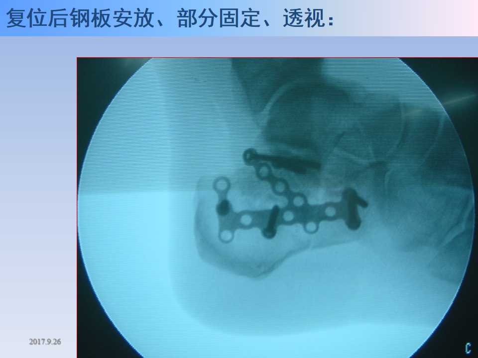 跟骨骨折的临床治疗方式及其要点