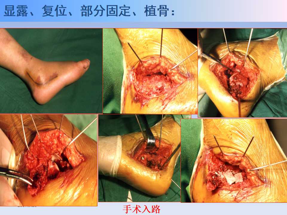 跟骨骨折的临床治疗方式及其要点