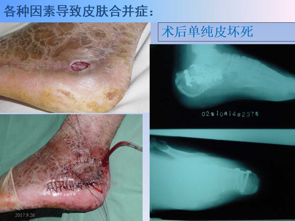 跟骨骨折的临床治疗方式及其要点