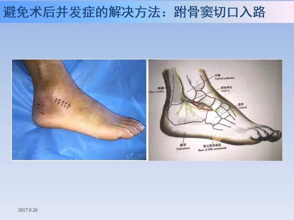 跟骨骨折的临床治疗方式及其要点