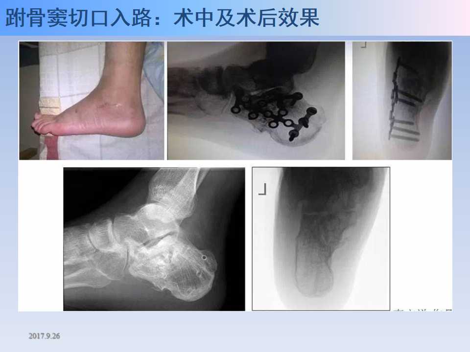 跟骨骨折的临床治疗方式及其要点