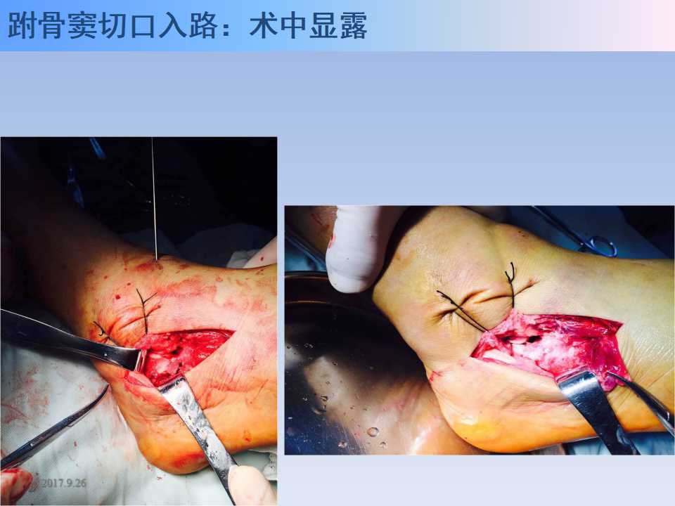 跟骨骨折的临床治疗方式及其要点