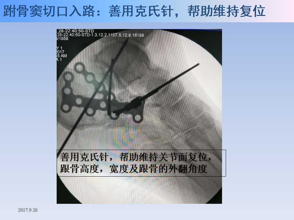 跟骨骨折的临床治疗方式及其要点