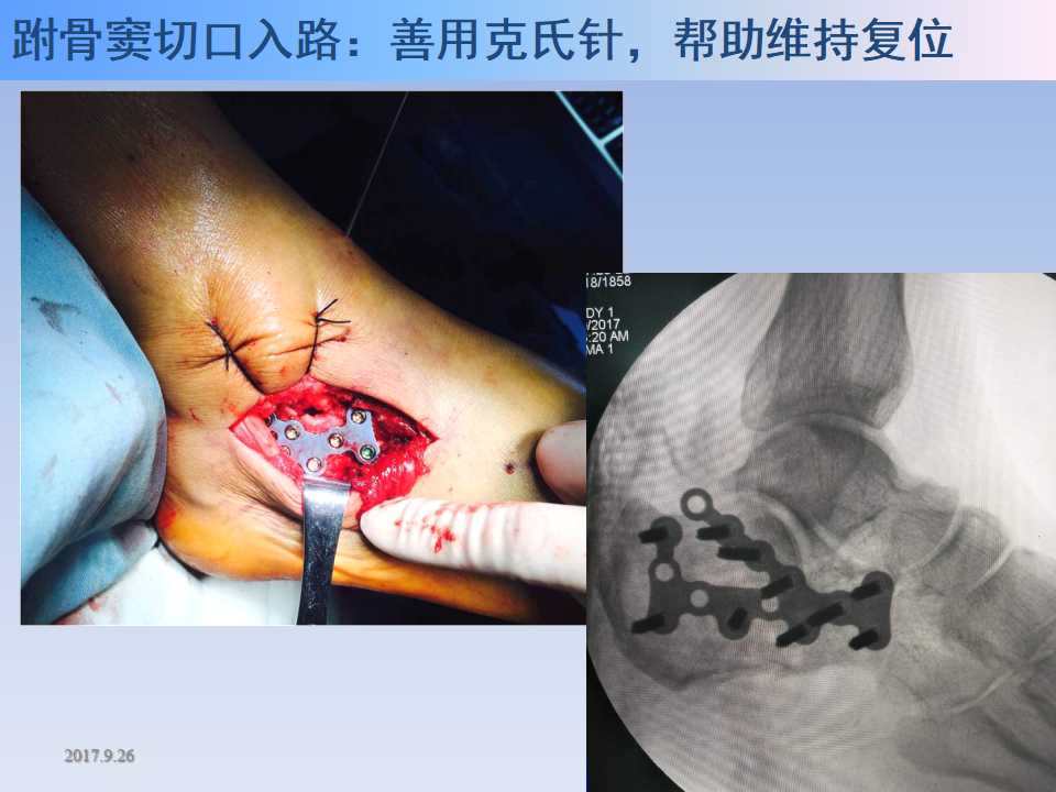 跟骨骨折的临床治疗方式及其要点