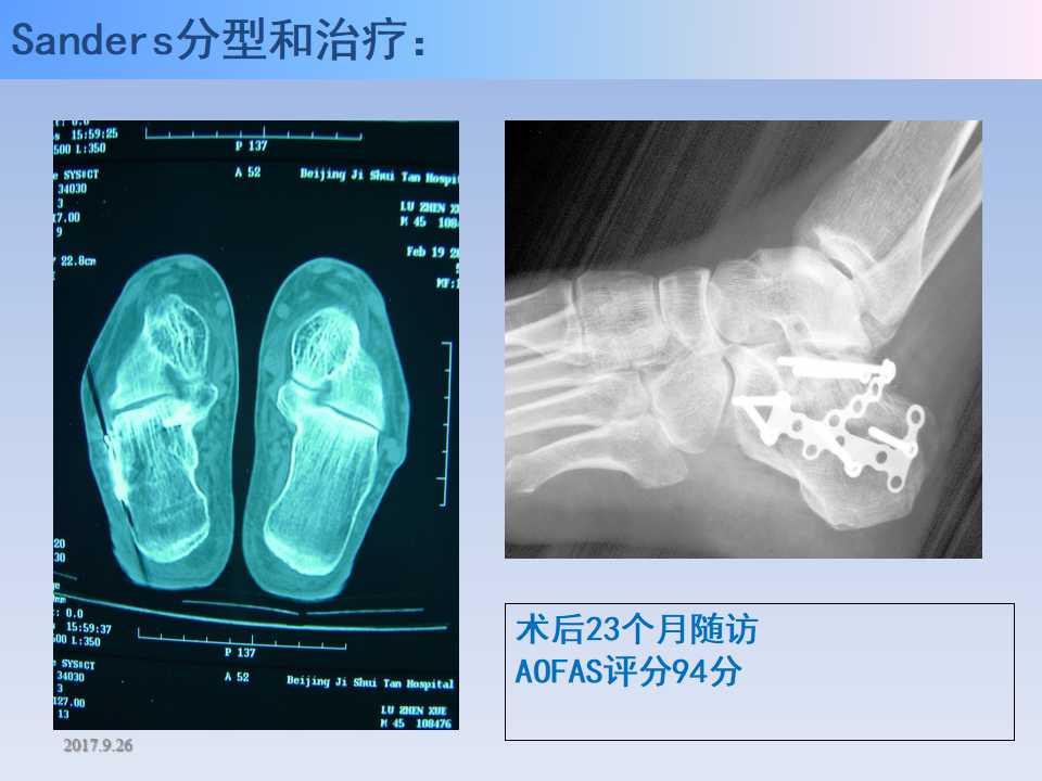 跟骨骨折的临床治疗方式及其要点