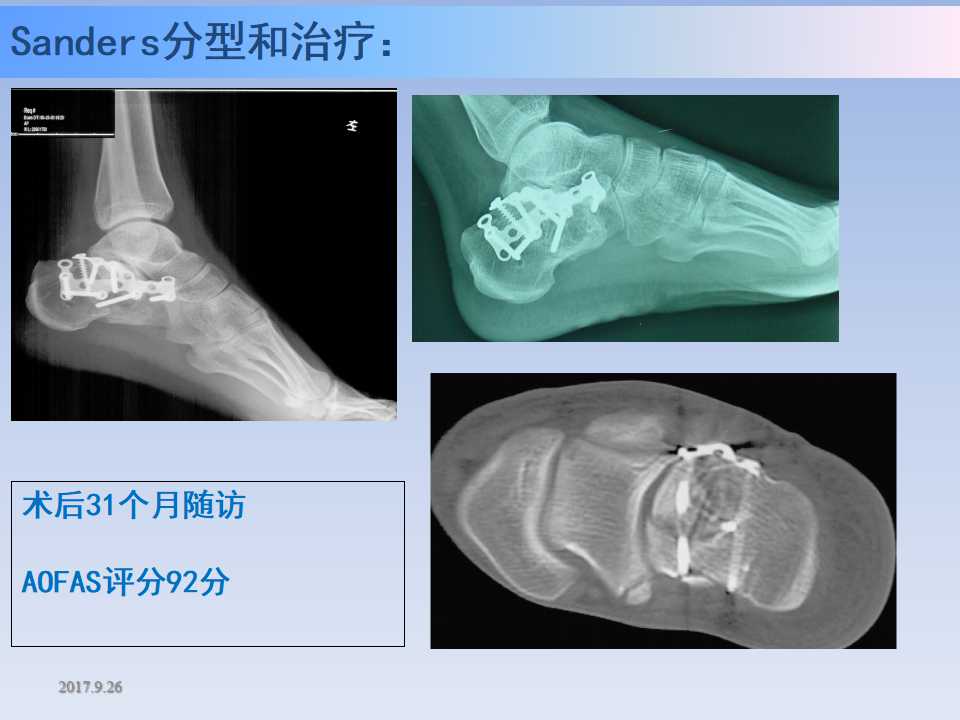 跟骨骨折的临床治疗方式及其要点