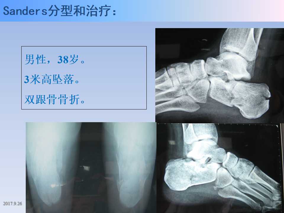 跟骨骨折的临床治疗方式及其要点