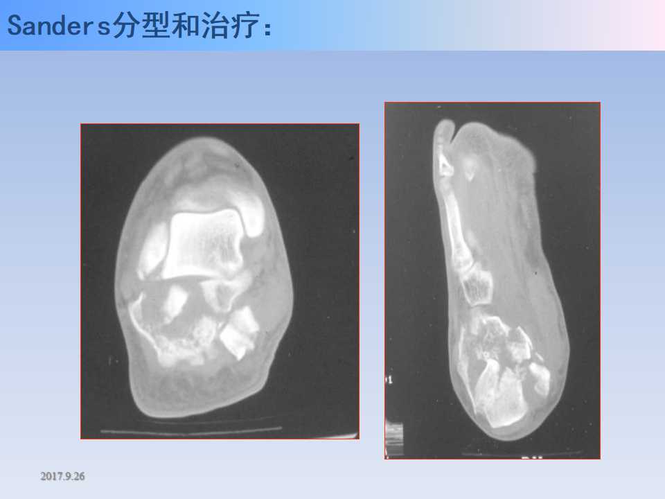 跟骨骨折的临床治疗方式及其要点