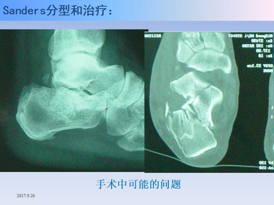 跟骨骨折的临床治疗方式及其要点