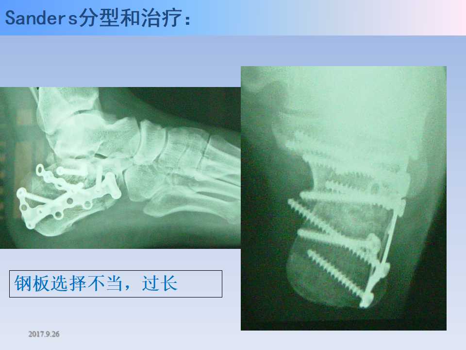 跟骨骨折的临床治疗方式及其要点