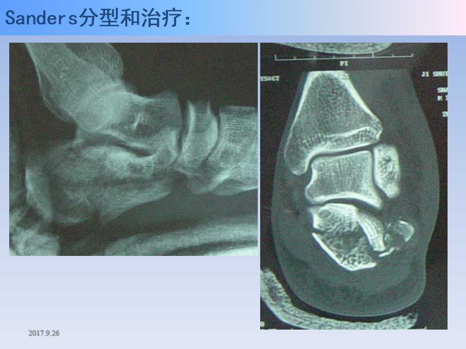 跟骨骨折的临床治疗方式及其要点