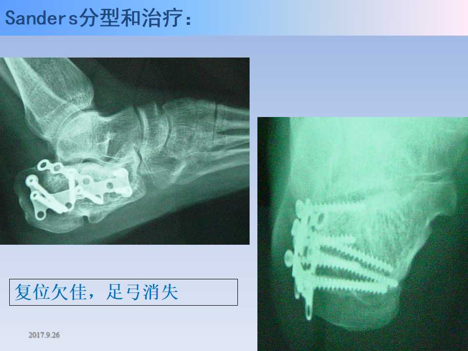 跟骨骨折的临床治疗方式及其要点