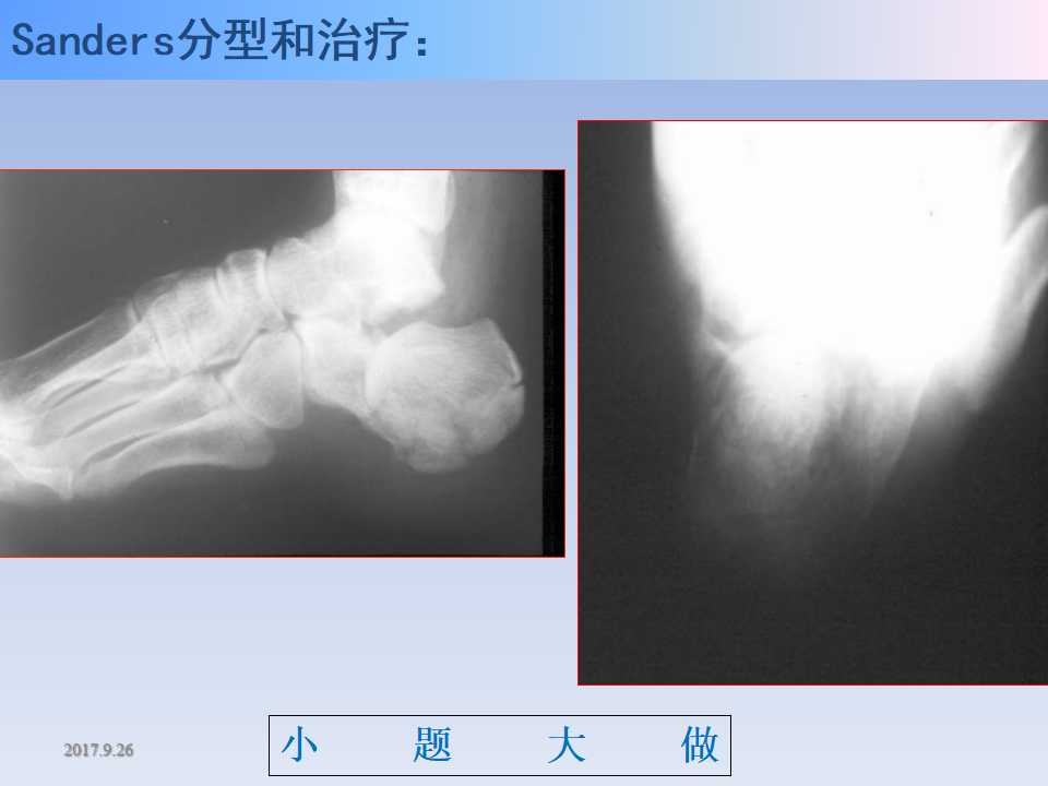 跟骨骨折的临床治疗方式及其要点