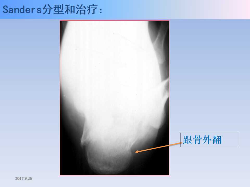 跟骨骨折的临床治疗方式及其要点