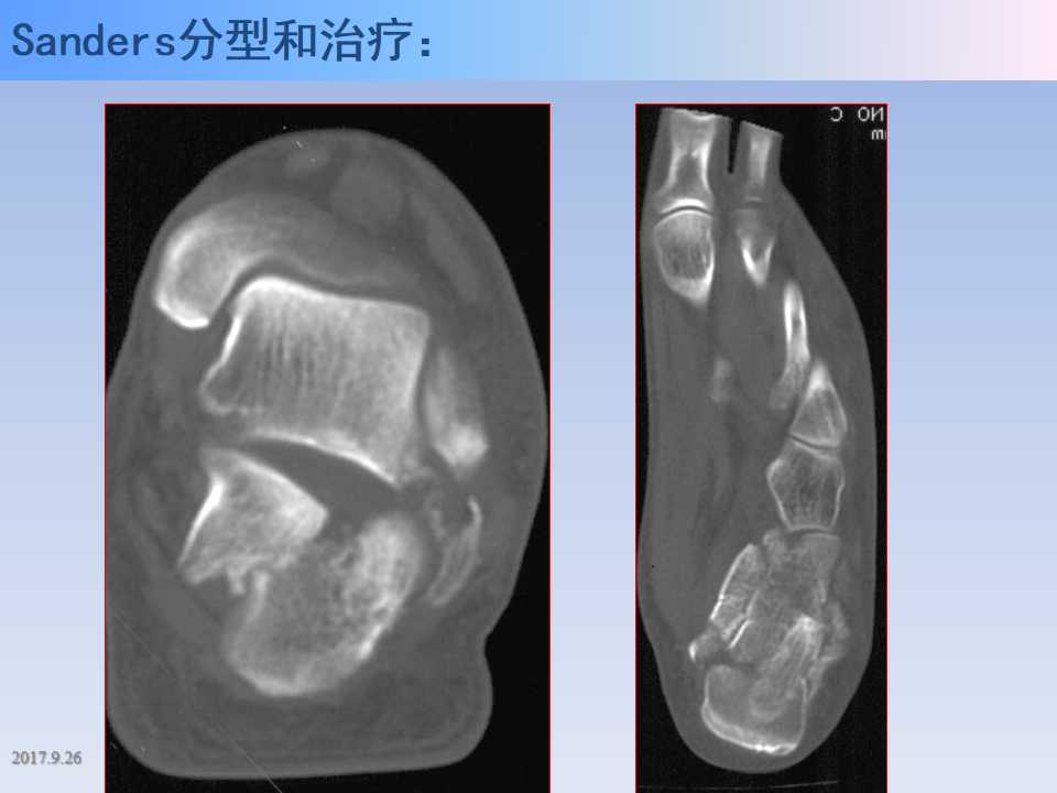 跟骨骨折的临床治疗方式及其要点