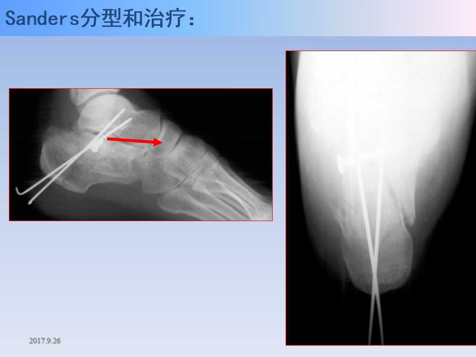 跟骨骨折的临床治疗方式及其要点