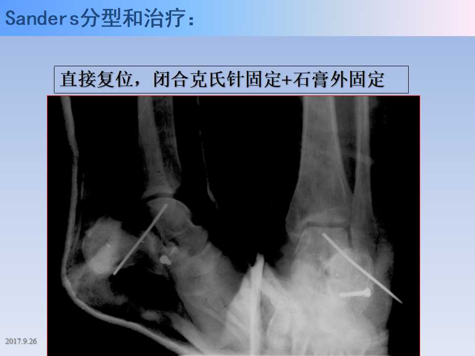 跟骨骨折的临床治疗方式及其要点