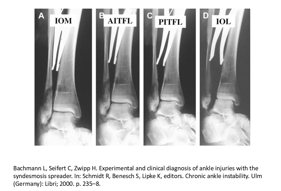 踝关节骨折治疗策略-重视关节内侧稳定