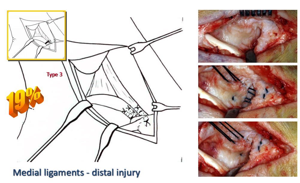 踝关节骨折治疗策略-重视关节内侧稳定