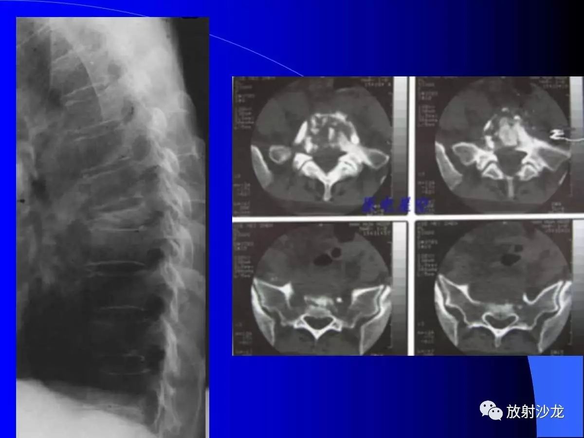 脊柱结核如何进行影像诊断？