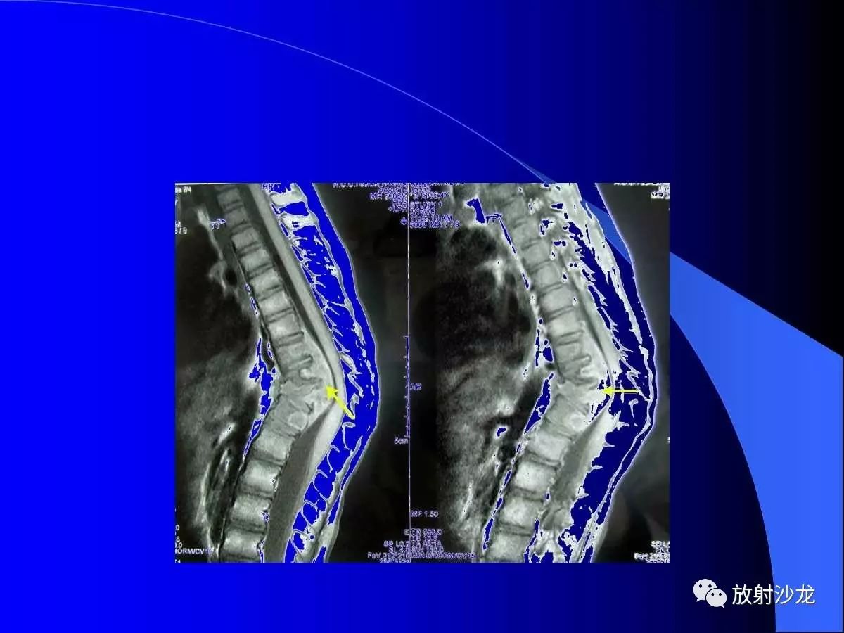 脊柱结核如何进行影像诊断？