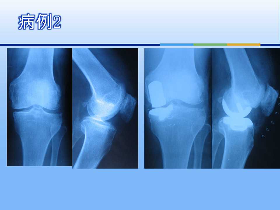 膝关节单髁置换术治疗骨性关节炎