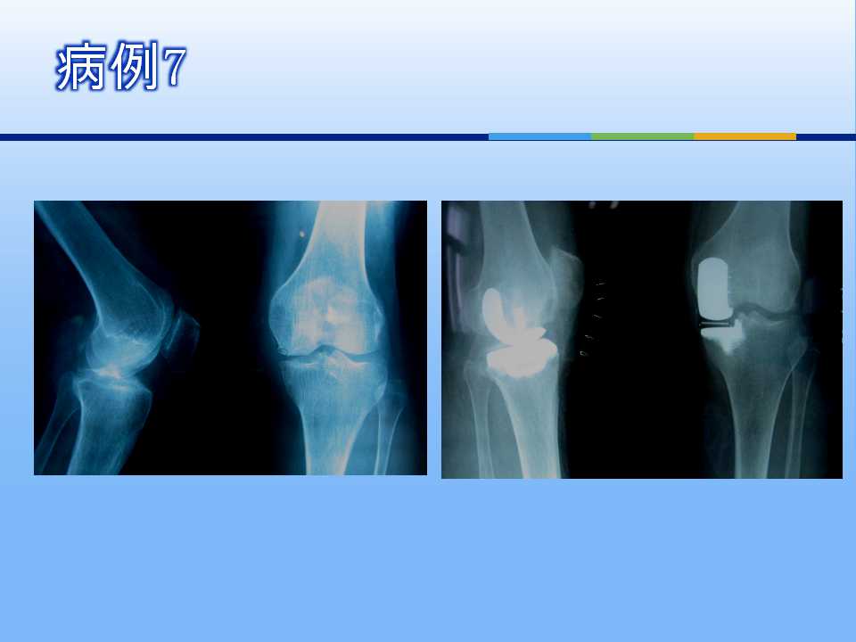 膝关节单髁置换术治疗骨性关节炎