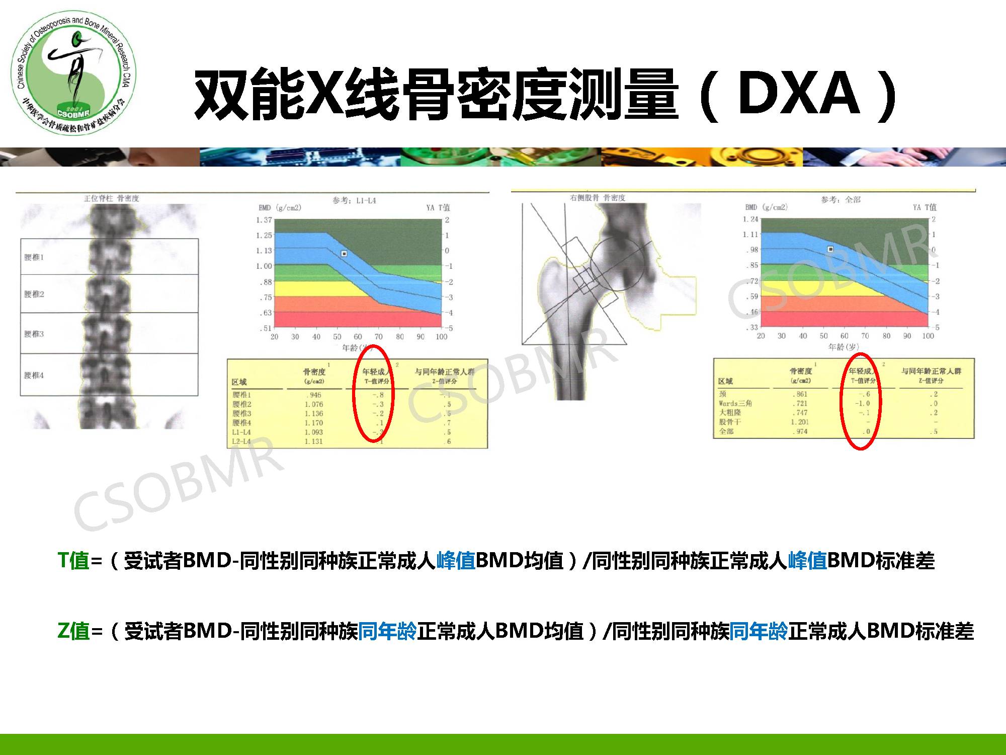 【指南】骨质疏松症临床表现、诊断及鉴别诊断