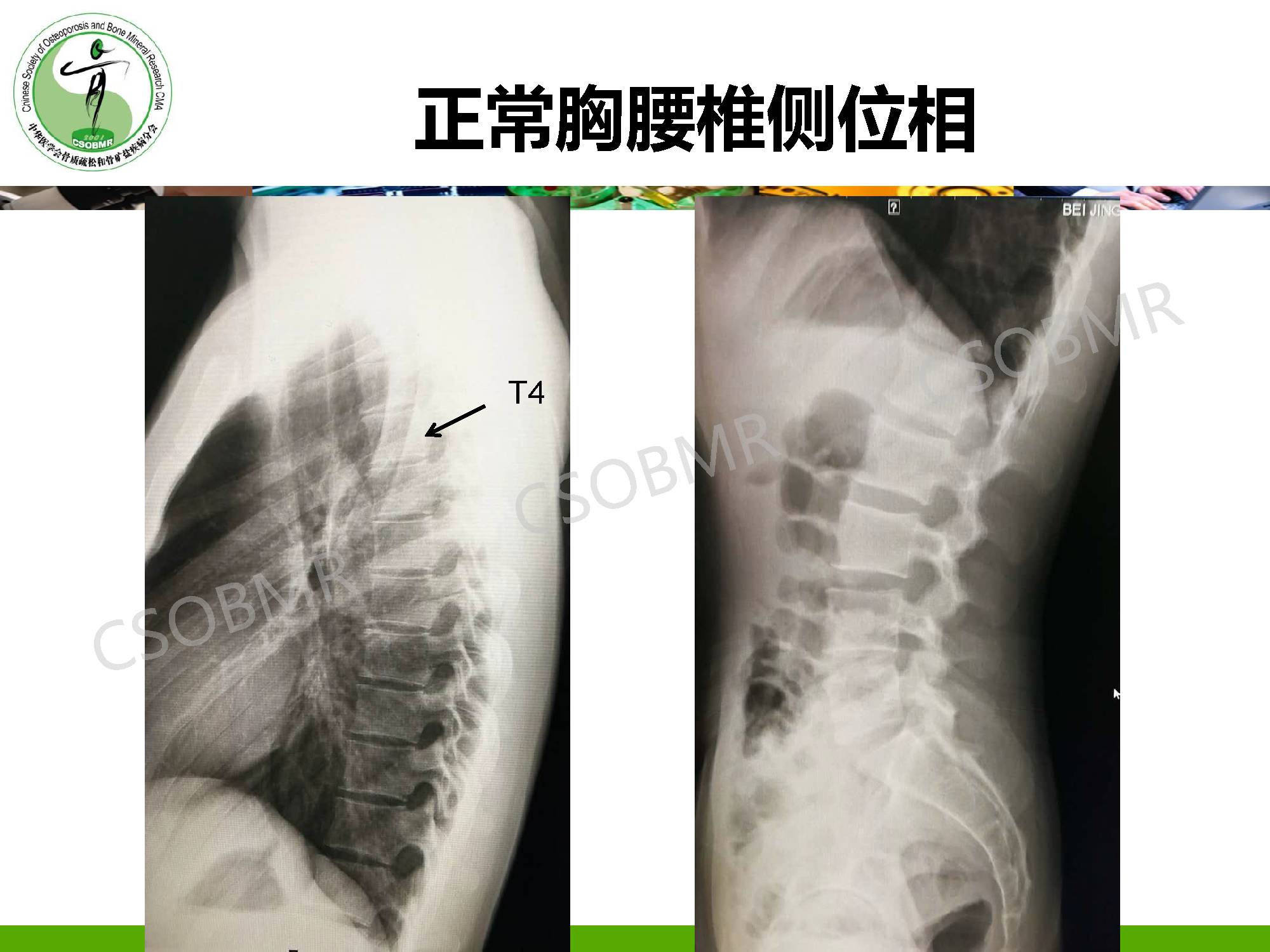 【指南】骨质疏松症临床表现、诊断及鉴别诊断