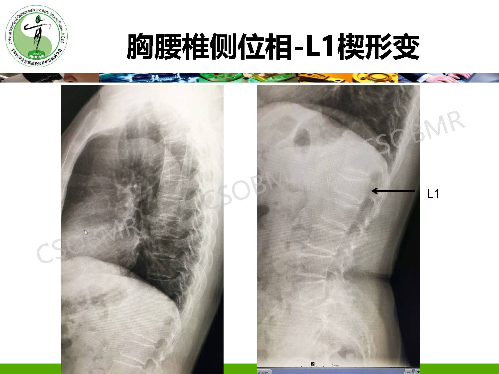 【指南】骨质疏松症临床表现、诊断及鉴别诊断