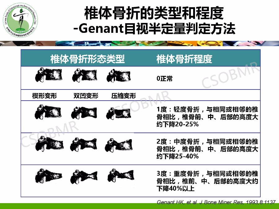 【指南】骨质疏松症临床表现、诊断及鉴别诊断