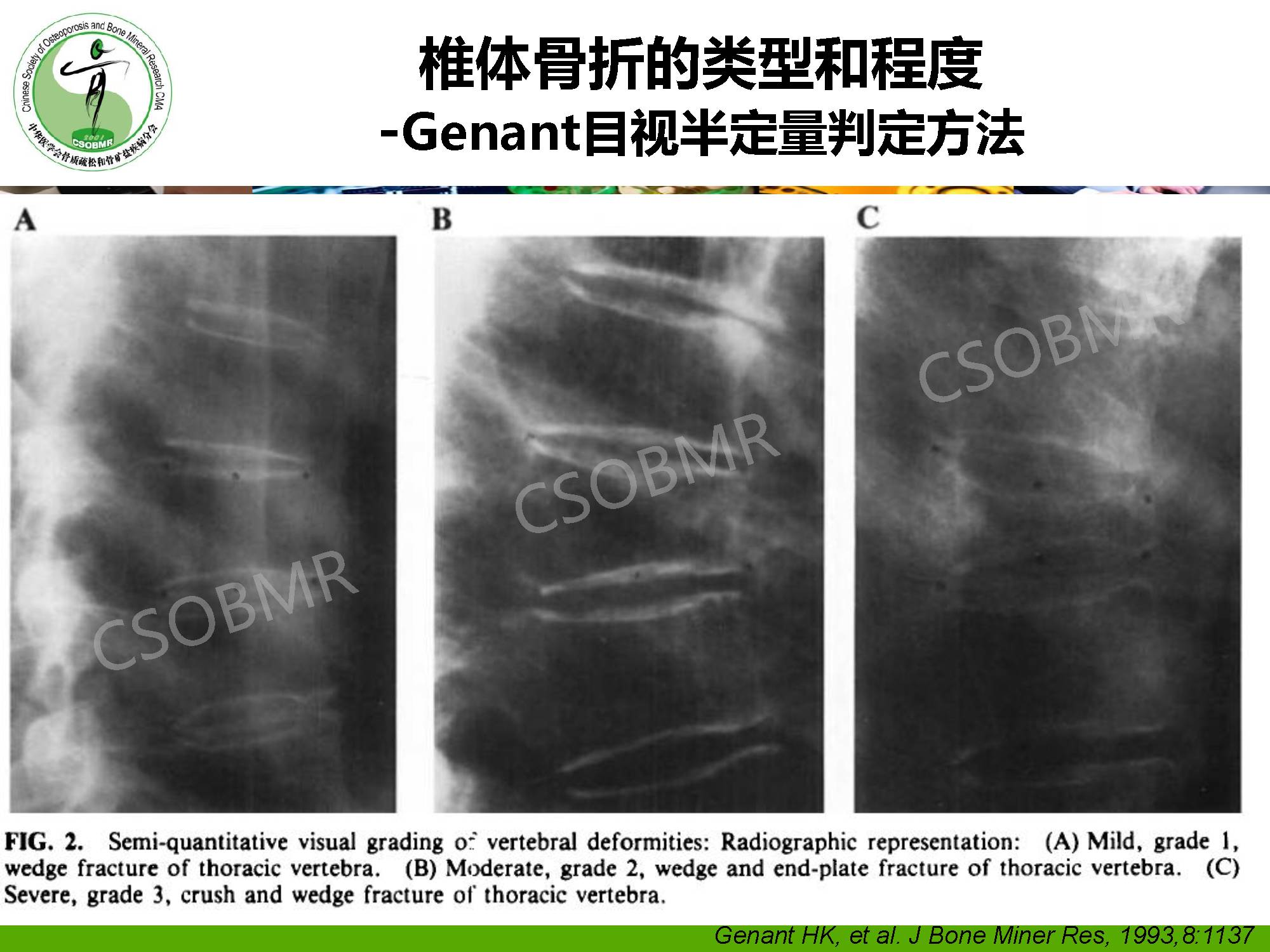 【指南】骨质疏松症临床表现、诊断及鉴别诊断