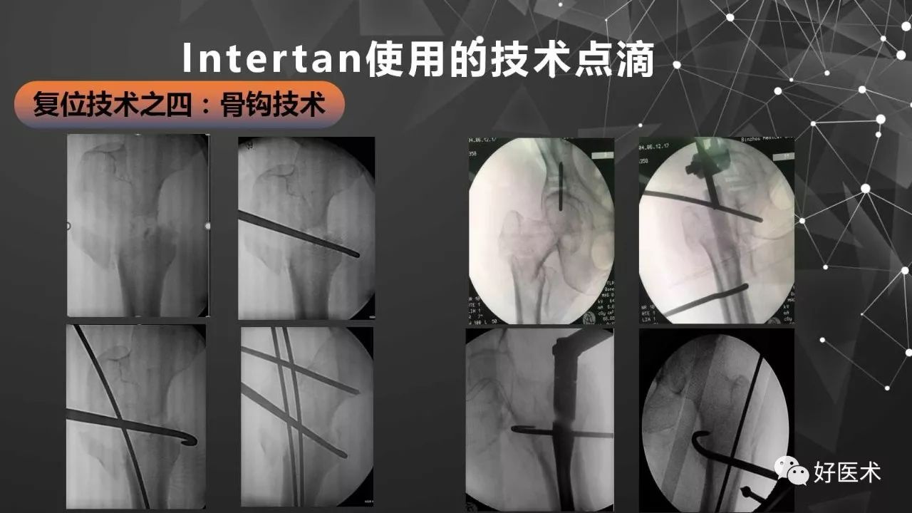 Intertan在股骨粗隆间骨折的应用及技术要点