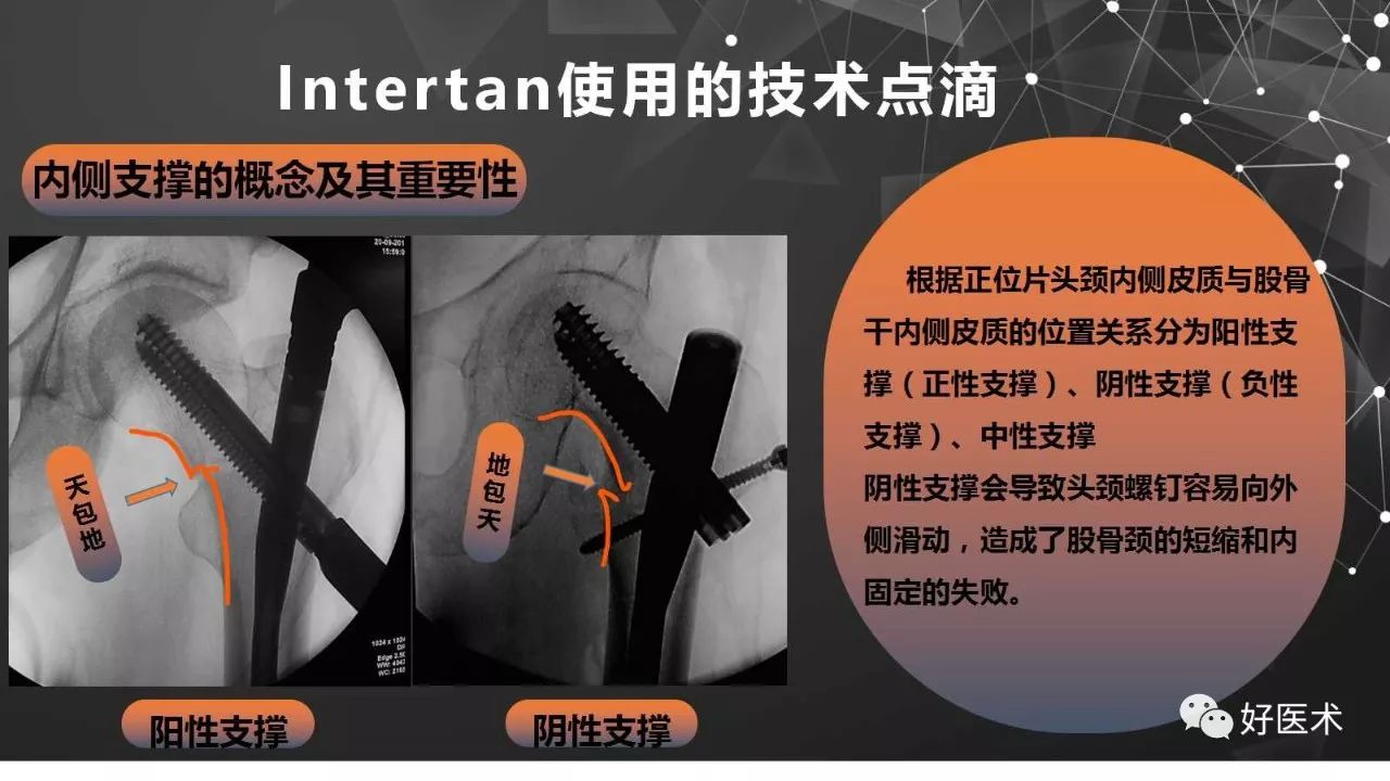 Intertan在股骨粗隆间骨折的应用及技术要点