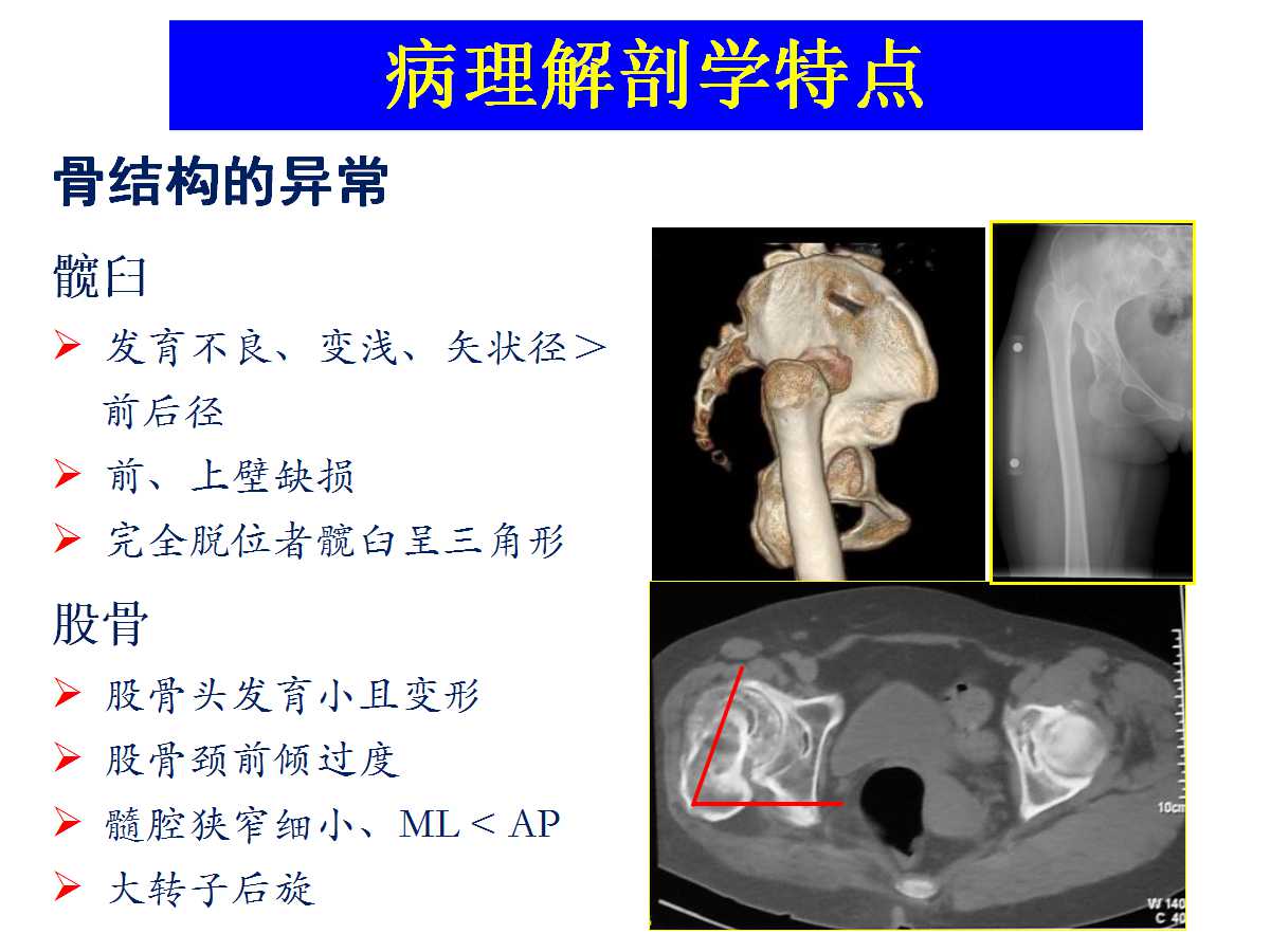 成人DDH的全髋关节置换技术