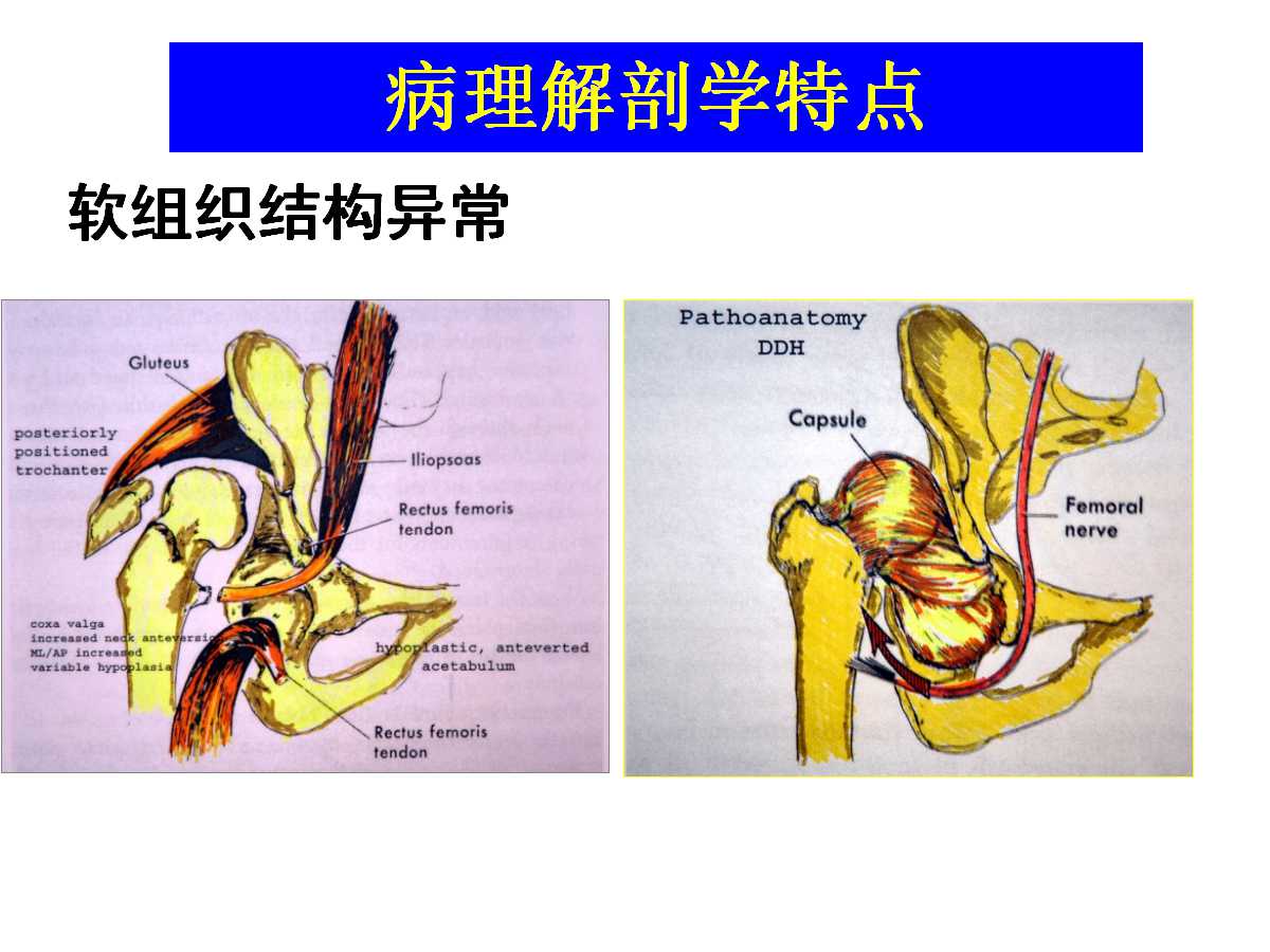 成人DDH的全髋关节置换技术