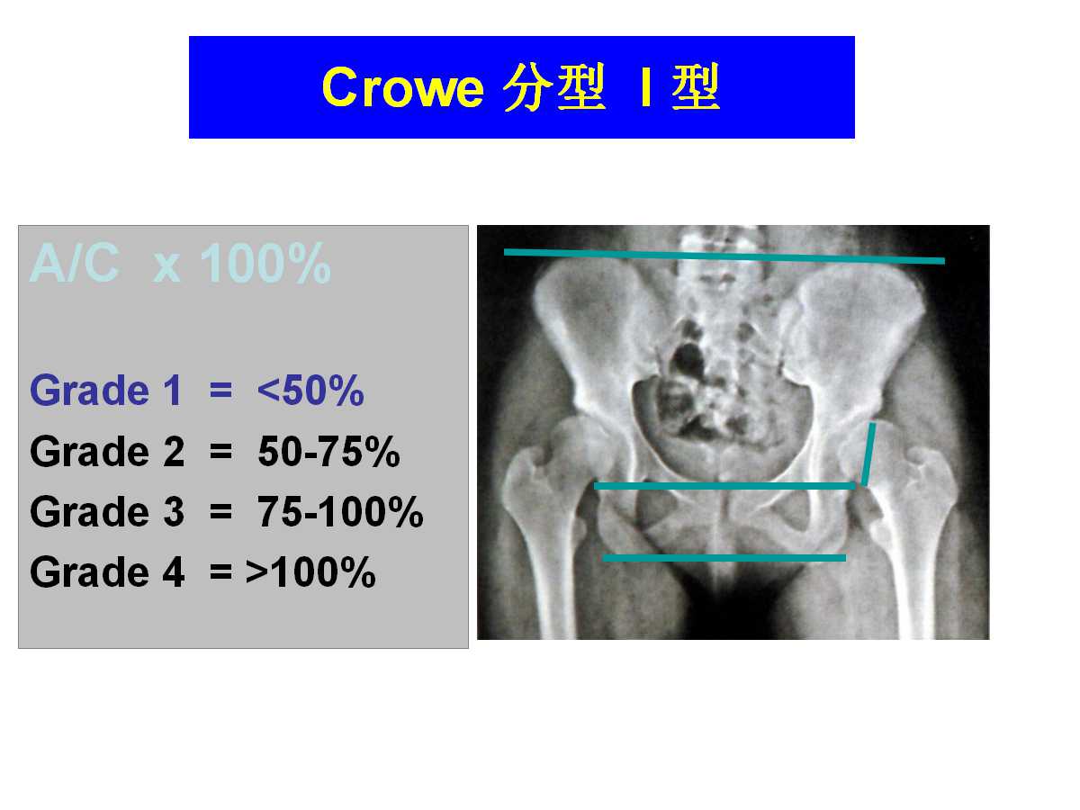 成人DDH的全髋关节置换技术