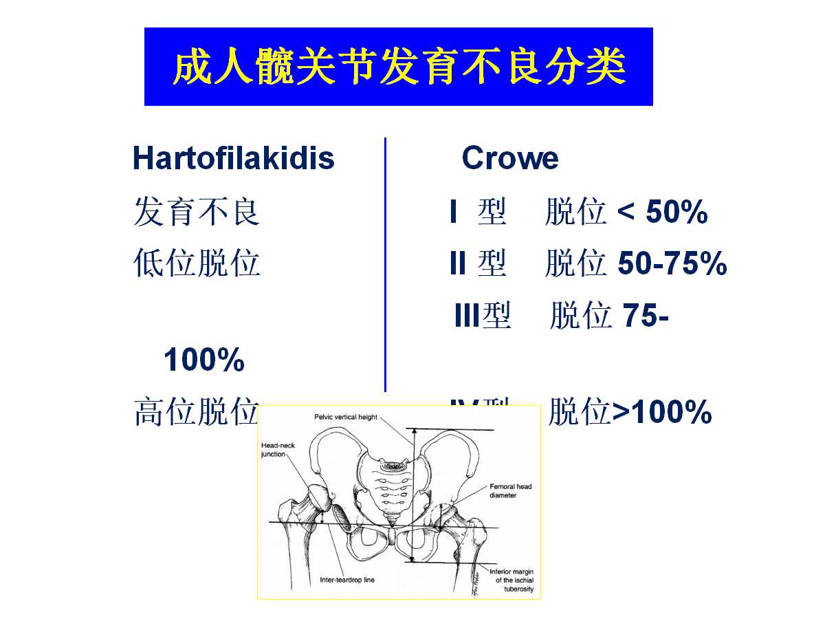 成人DDH的全髋关节置换技术