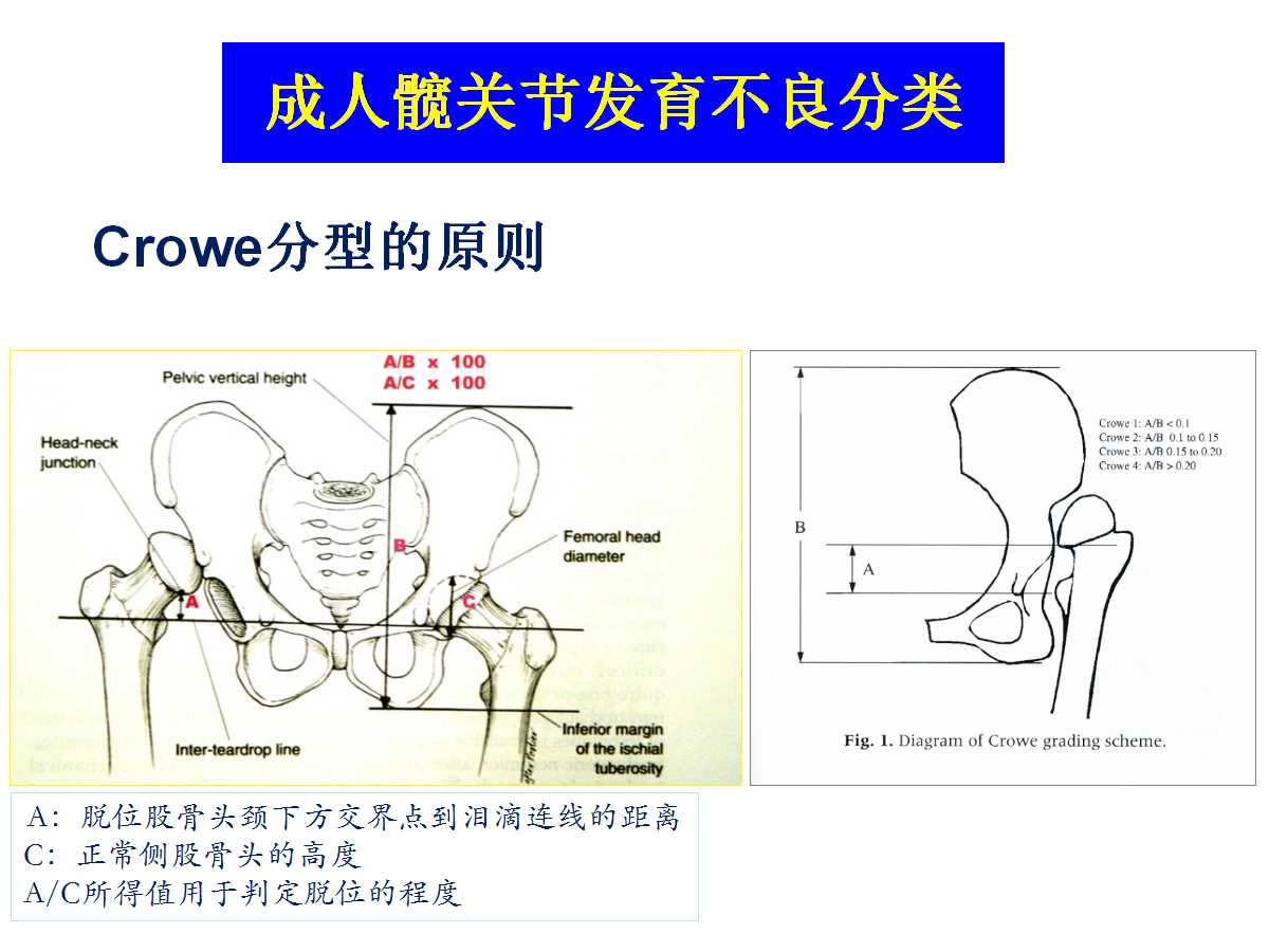 成人DDH的全髋关节置换技术