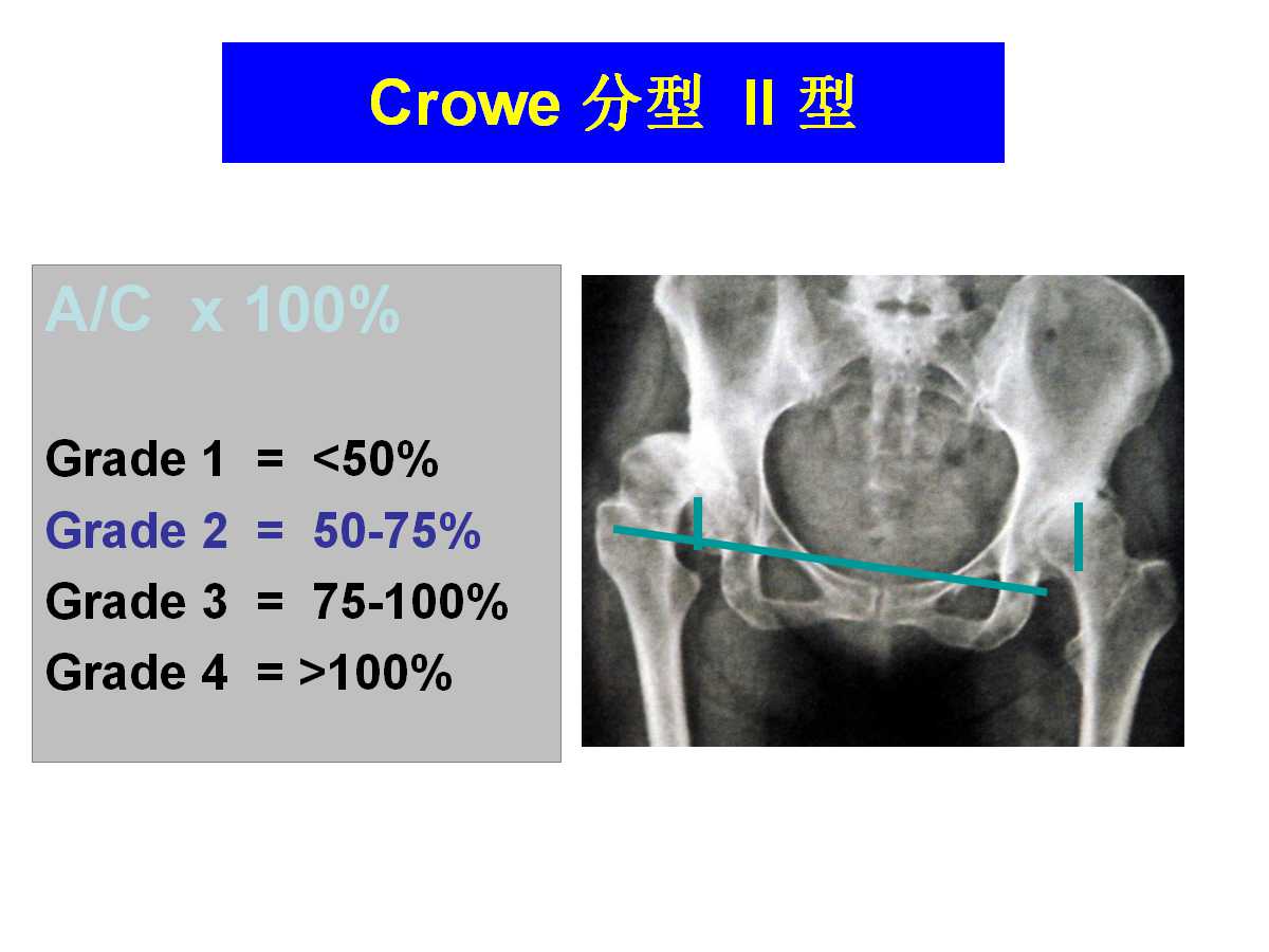 成人DDH的全髋关节置换技术