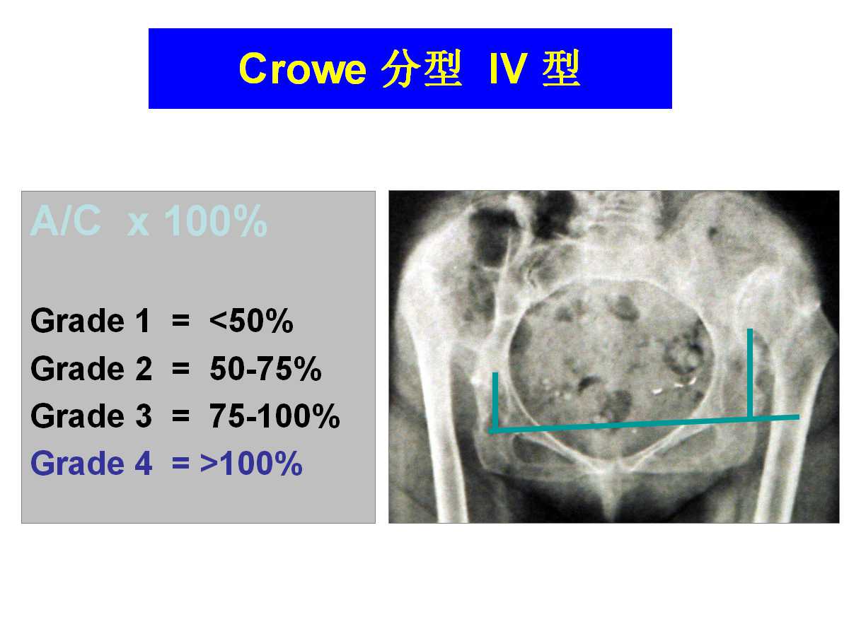 成人DDH的全髋关节置换技术