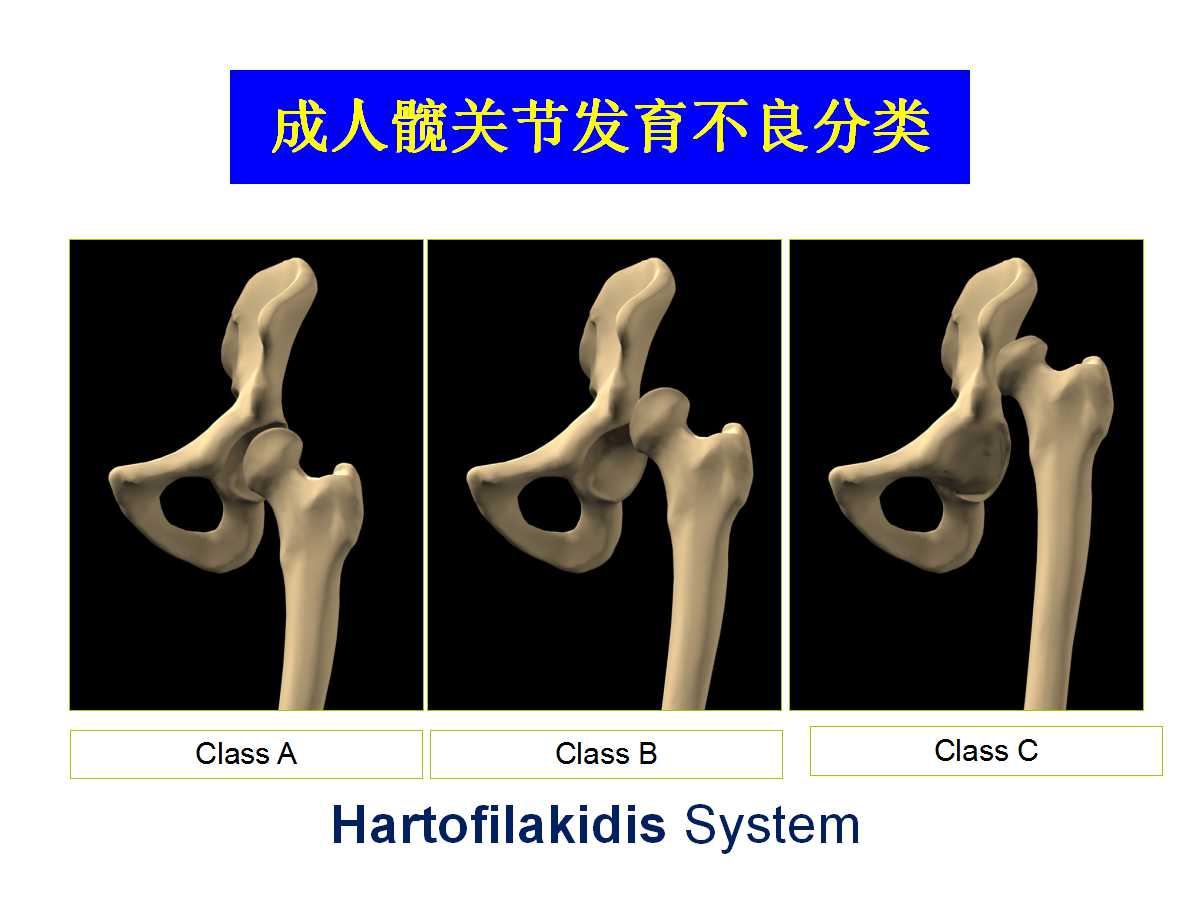 成人DDH的全髋关节置换技术