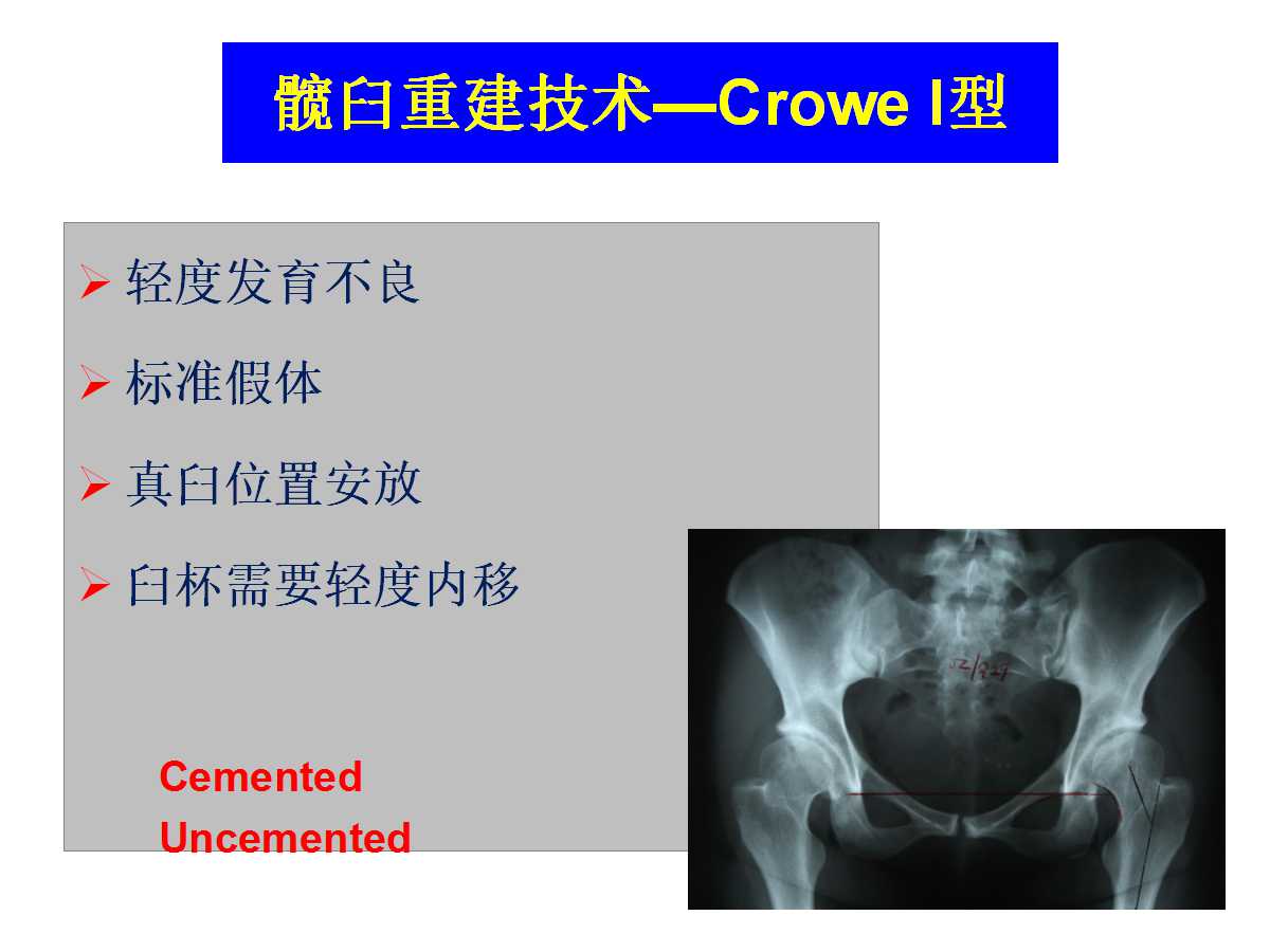 成人DDH的全髋关节置换技术