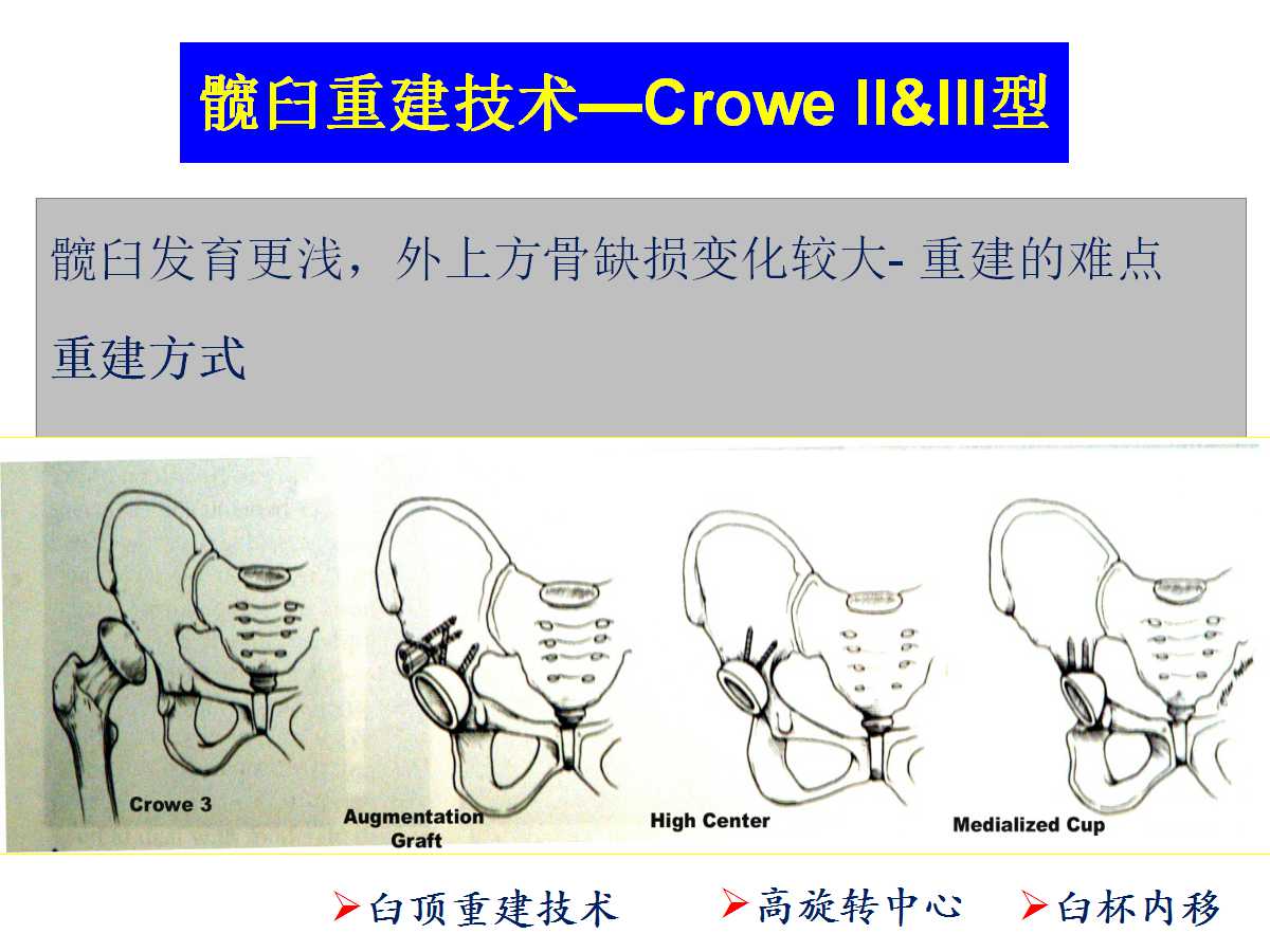 成人DDH的全髋关节置换技术