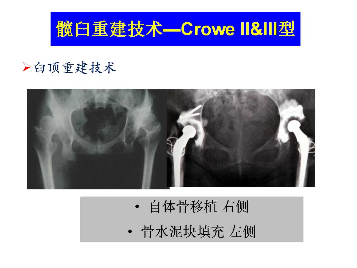 成人DDH的全髋关节置换技术