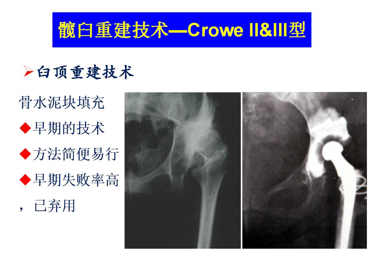 成人DDH的全髋关节置换技术