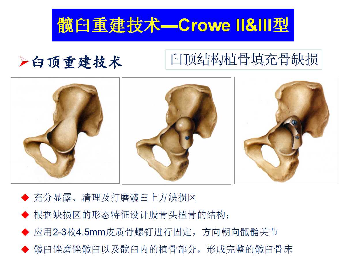 成人DDH的全髋关节置换技术