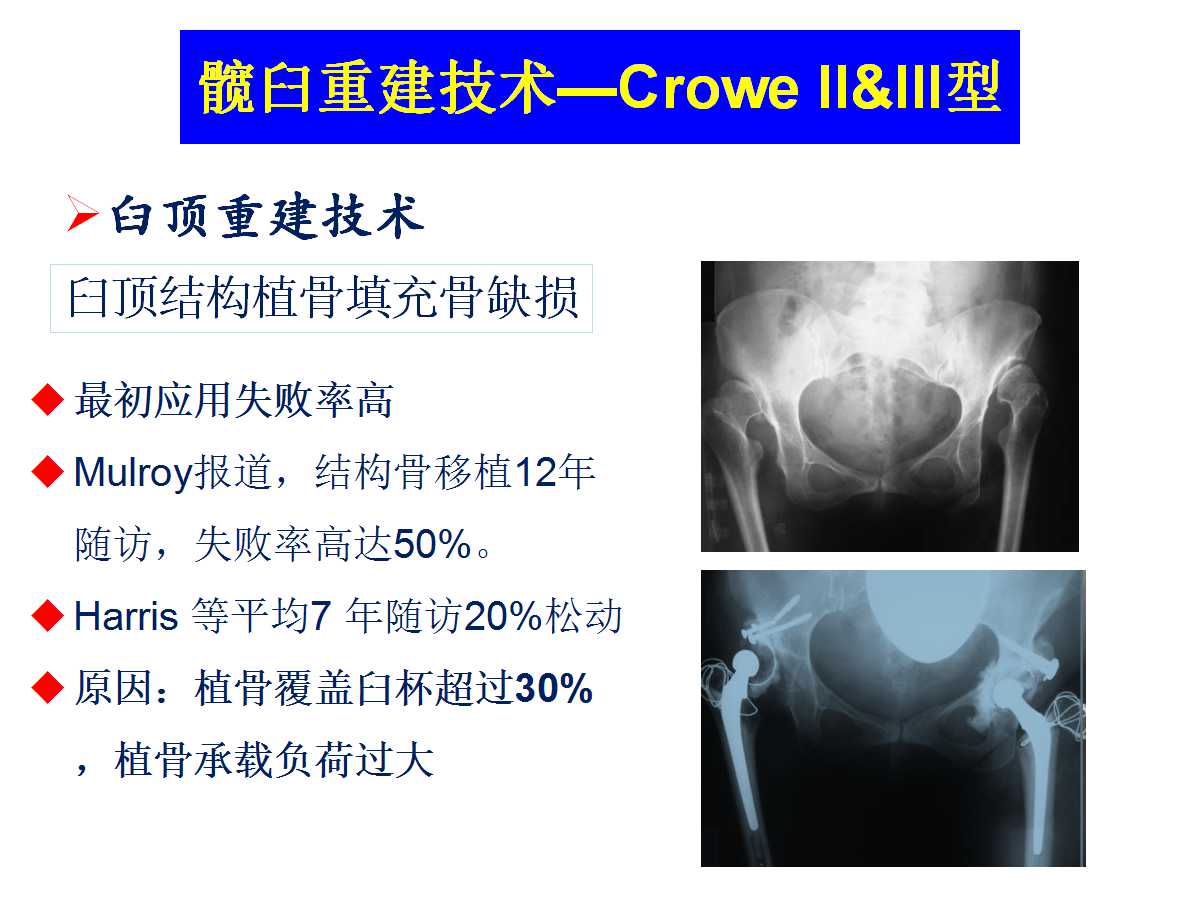 成人DDH的全髋关节置换技术