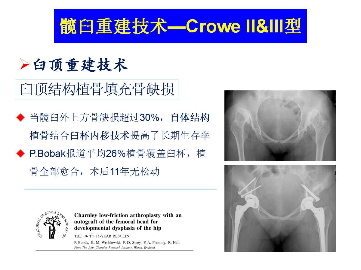 成人DDH的全髋关节置换技术